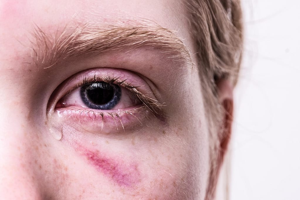 trauma, injured, tear, traumatized, pain, injury, cry, hematoma, tormented, suffering, eye, bruise, problem, tears, girl