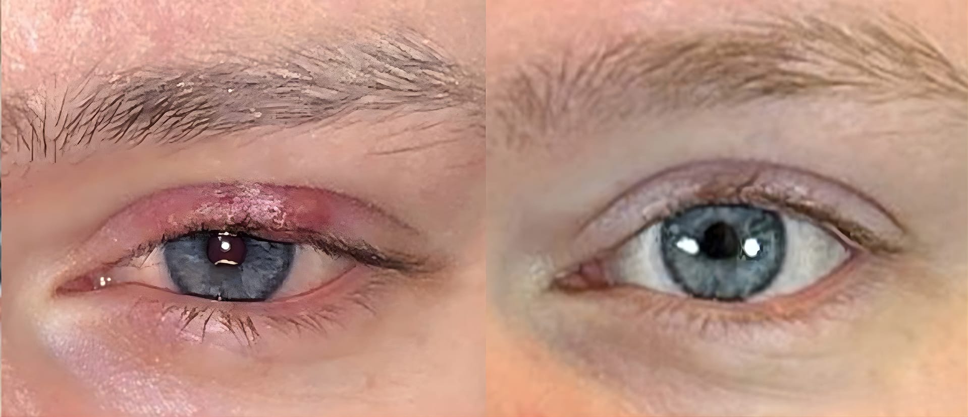 dry eyes2