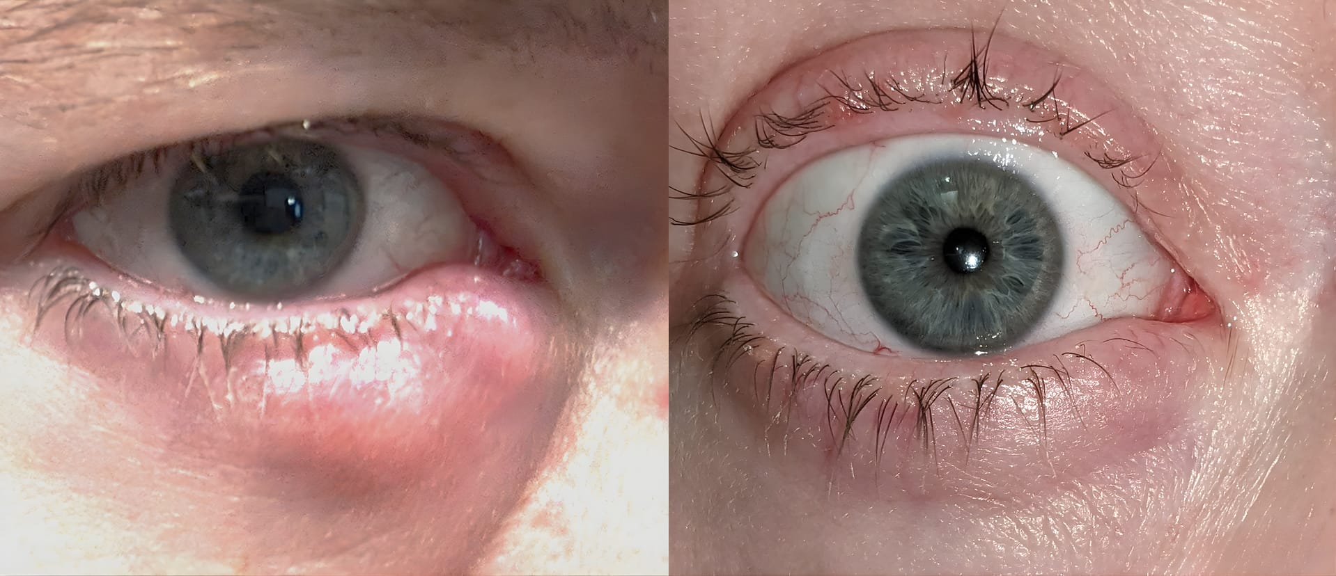 dryeyes1